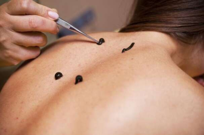 Uzmanından merdiven altı 'sülük' ve 'hacamat' uyarısı