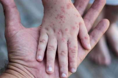 Bakan Koca'dan 'kızamığa bağlı ölüm' iddialarına yanıt