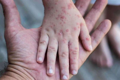 Sağlık Bakanlığı'ndan 81 il valisine 'kızamık' yazısı