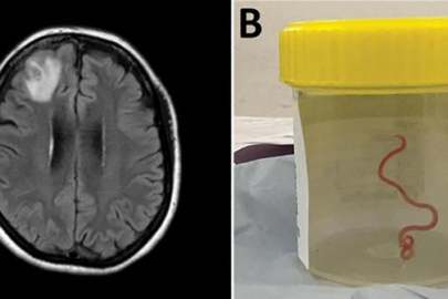 Dünyada ilk  hastanın beyninden canlı solucan çıkarıldı
