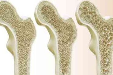 Uzmanı uyardı: Bu hastalık çok sinsi ilerliyor