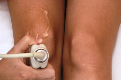 Diz kireçlenmesine göbek kordonuyla tedavi