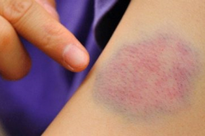 Türkiye hemofili tedavisinde ilk 10'da