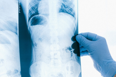 Akciğer kanserinde tarama yöntemleri hayat kurtarıyor