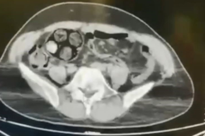 İranlı şahsın bağırsaklarından uyuşturucu çıkarıldı