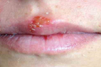 'Uçuk'lar kalıcı zarar verebilir!