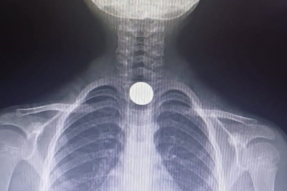 Yuttuğu madeni para yemek borusuna takıldı