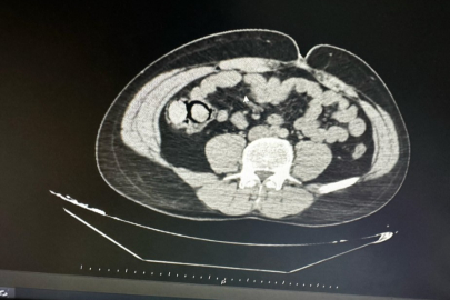 Bu kadarına da pes: Midelerinden 10 parça halinde uyuşturucu çıktı