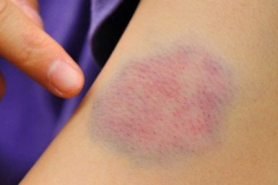 Hemofiliyle yaşam mümkün tedavisinde umut var!