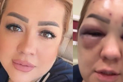 Botoks bu hale getirdi: Yüzü şişti tanınmayacak hale geldi