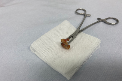 Uykusunda yuttuğu dişler bronşundan çıkarıldı