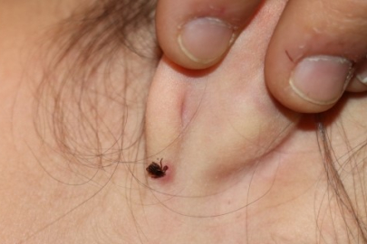 Havaların ısınmasıyla birlikte kenelerle temas riski arttı