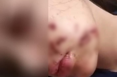 Yüzüne maytap isabet eden genç kız yaralandı