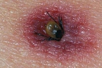 Uzmanlardan 'kene' uyarısı: "Belirtiler keneye has değil, hemen ortaya çıkmayabiliyor"