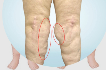 İstenmeyen kiloların kaynağı lipödem olabilir