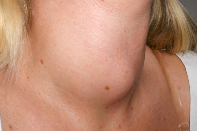 Boynunuzda şişlik varsa dikkat !