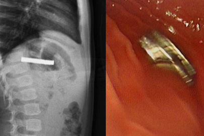 Çocuğun boğazından 19 adet mıknatıs çıkartıldı