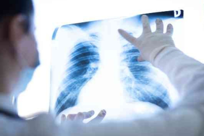 Akciğer kanseri: Sinsi ilerliyor, ama önlemek elimizde!