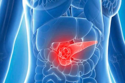 Belirti vermeyen sessiz katil, pankreas kanseri