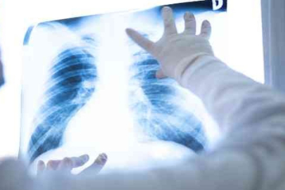 Akciğer hastalıklarında cerrahisiz teşhis dönemi: EBUS