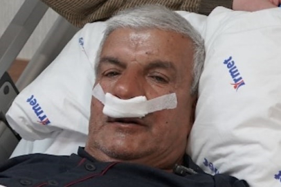 65 yaşındaki adamın burnundan 100 gramlık taş çıkarıldı