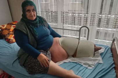 Fil hastalığı bacağını 100 kilo yaptı, tedavisinin devamı için destek bekliyor