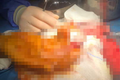 Buz torbasıyla taşınan parmak 14 saat sonra hayata döndü