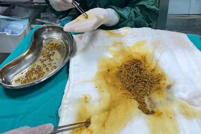 Bingöl’de şaşırtan ameliyat: Safra kesesinden 2 bin 67 taş çıkarıldı