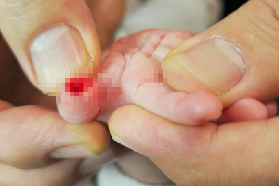 Hastanede ihmal iddiası: 5 aylık bebeğin parmağı koptu