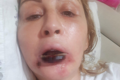Estetik işlem sonrası açılan davada 994 bin TL'lik tazminat kararı