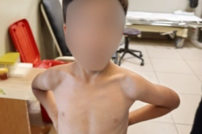 İnegöl'de 7 yaşındaki çocuğun göğsüne kene yapıştı