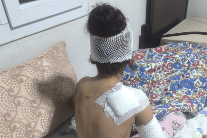 Köpeklerin saldırdığı kızın vücuduna 150 dikiş atıldı