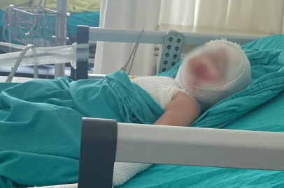 Patlayan domates konservesi 9 aylık bebeği yaktı