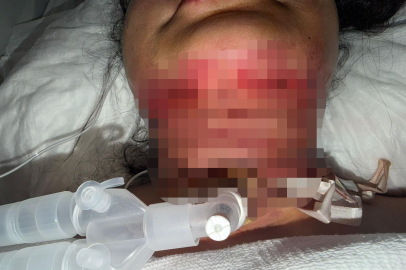 Gıdı aldırma operasyonu kabusa döndü: Boynundan delik açıldı