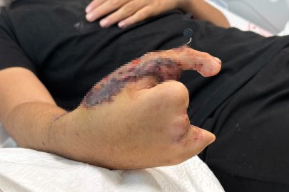 10 saatlik mucize ameliyat: Kıyma makinesinde elini kaybeden çocuğa ayak parmağı nakledildi