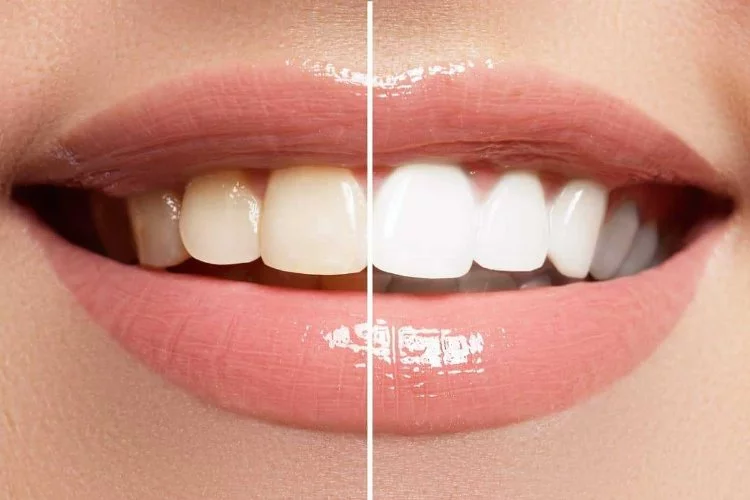 Diş beyazlatmanın faydalarını biliyor musunuz?